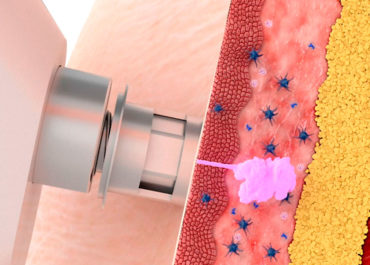 Inyectores sin aguja para la vacunación intradérmica porcina: la importancia de la precisión